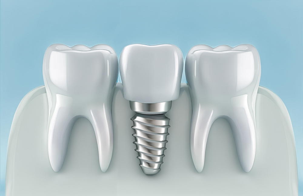 top implant dentist in groton
